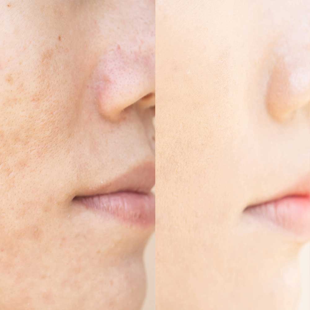 How does the IPL Acne Treatment work?