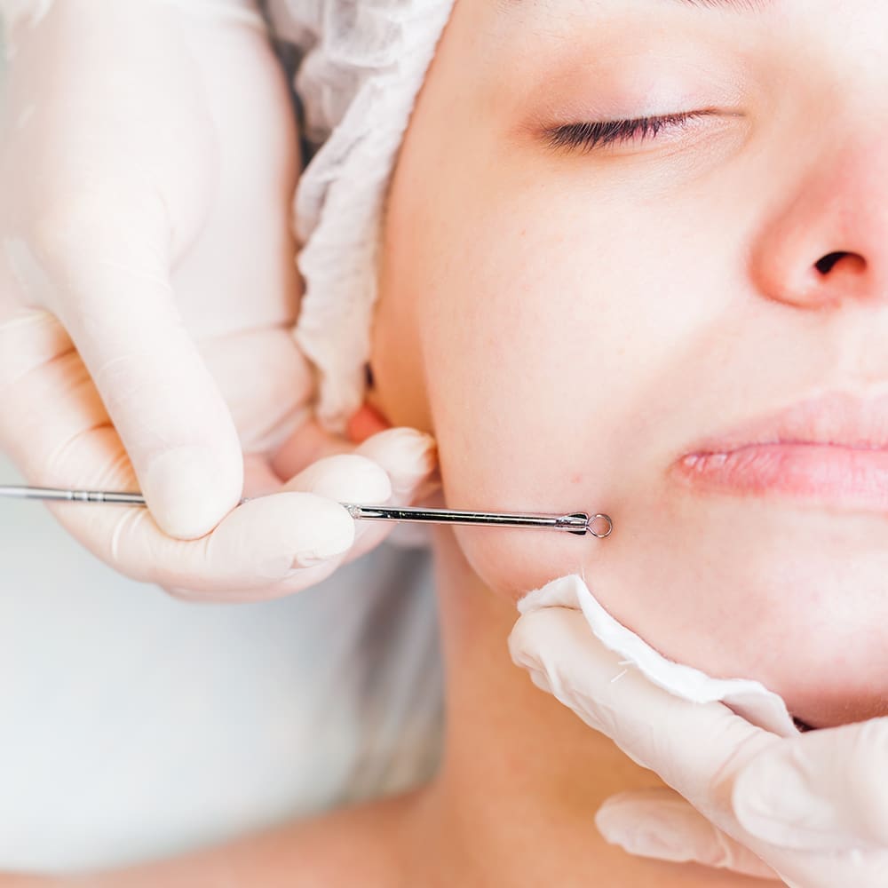 What happens during an Acne Cleansing?