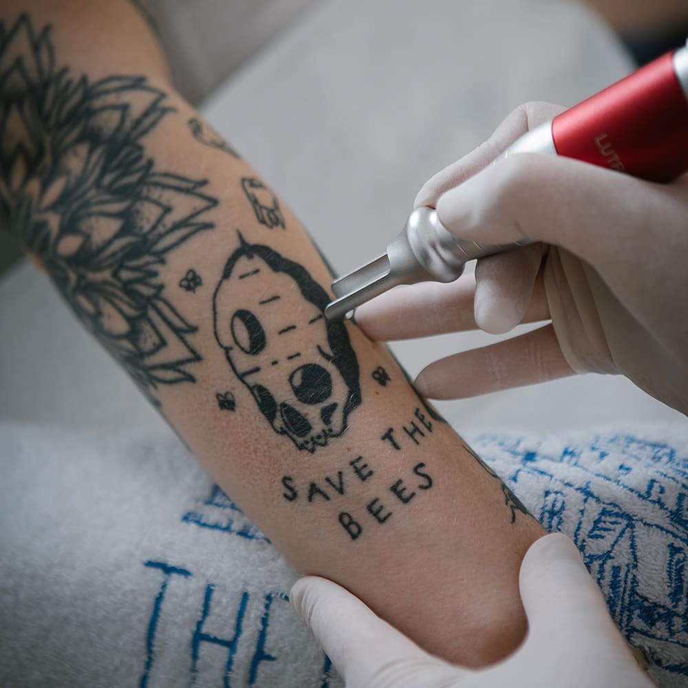 What distinguishes our method of tattoo removal from older nanosecond lasers (Q-switch lasers)?