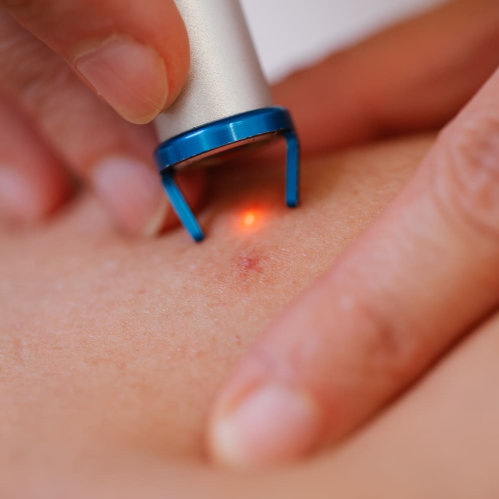 What happens during an IPL treatment for redness?