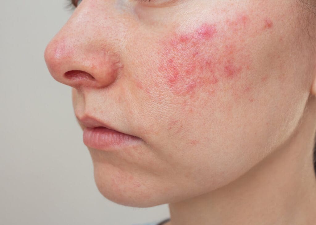 Rosazea  richtig behandeln