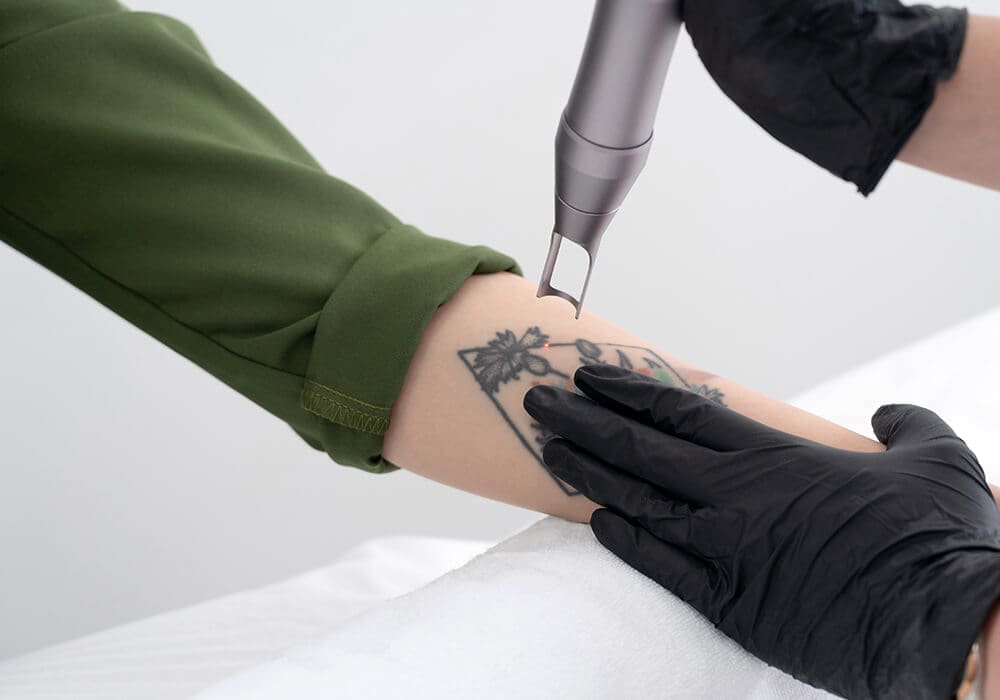 Tattoo removal