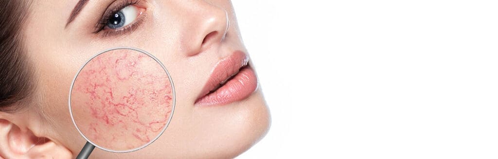 Rosazea-Trigger:  Auslöser erkennen und minimieren