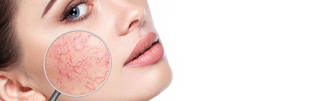 Detailaufnahme Rosacea Symptome