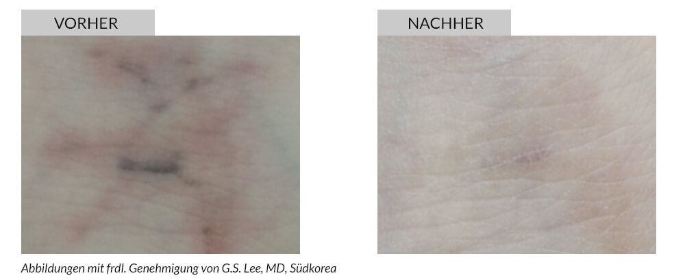 Tattoo Removal Before After