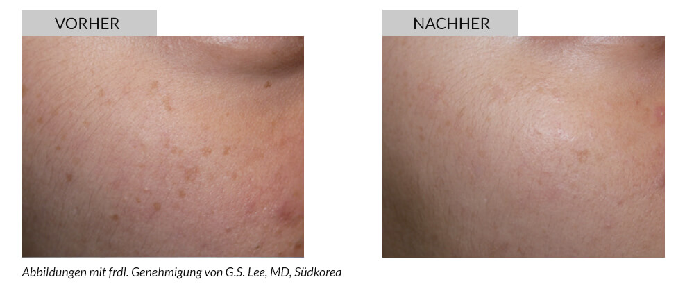 Tattoo Removal Before After