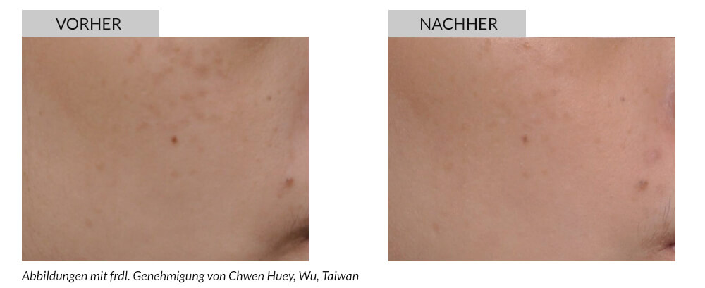 Tattoo Removal Before After