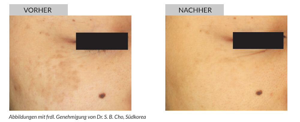 Tattoo Removal Before After