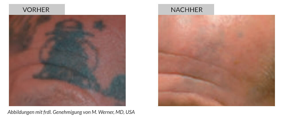 Tattoo Removal Before After