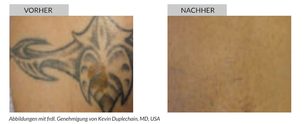 Tattoo Removal Before After