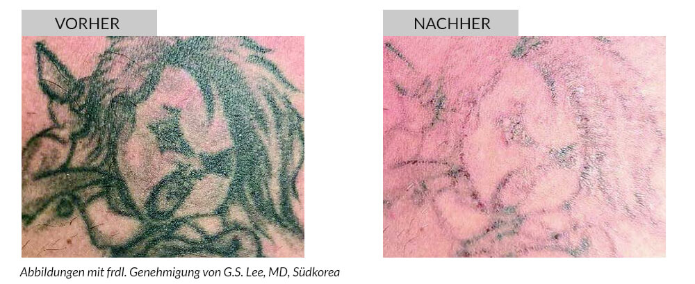 Tattoo Removal Before After