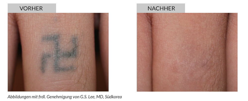 Tattoo Removal Before After