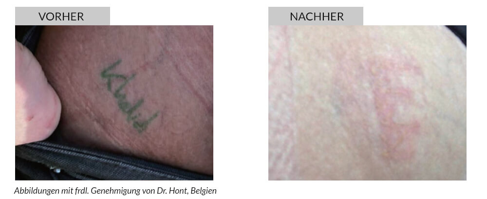 Tattoo Removal Before After
