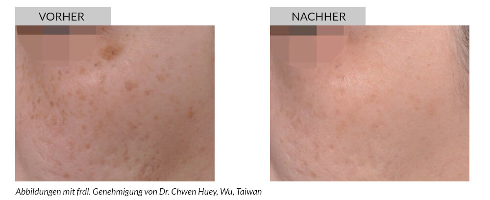 Tattoo Removal Before After