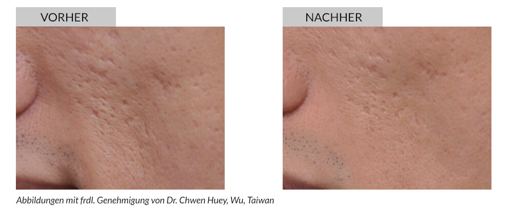 Tattoo Removal Before After