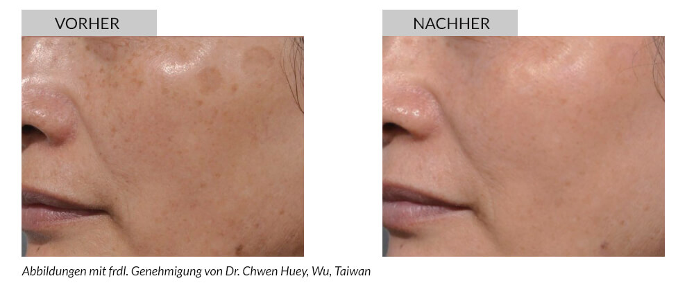 Tattoo Removal Before After