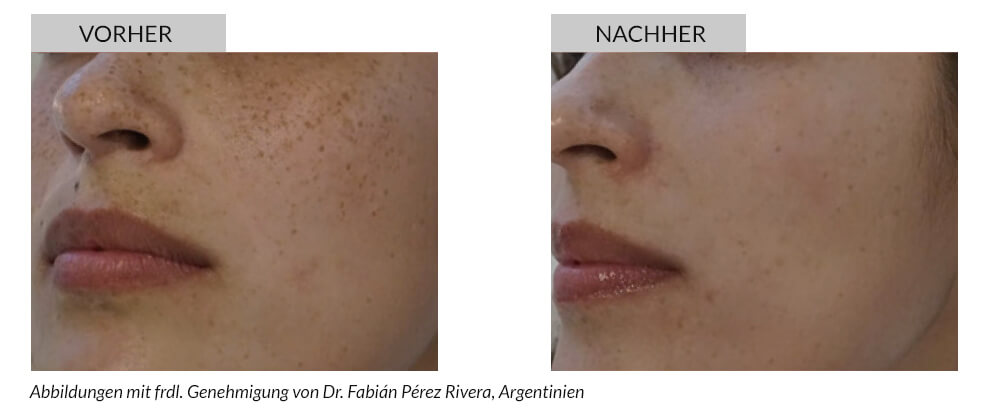 Tattoo Removal Before After