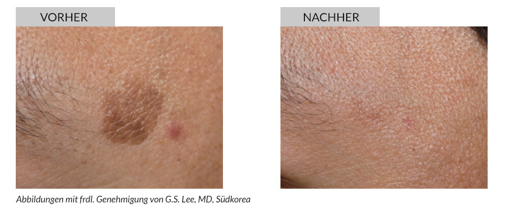 Tattoo Removal Before After