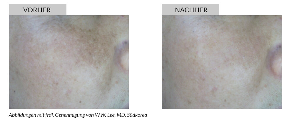 Tattoo Removal Before After